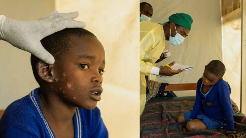 What is bird flu pandemic? : latest updates and insights 2 what is bird flu pandemic? : latest updates and insights Mpox outbreak in africa